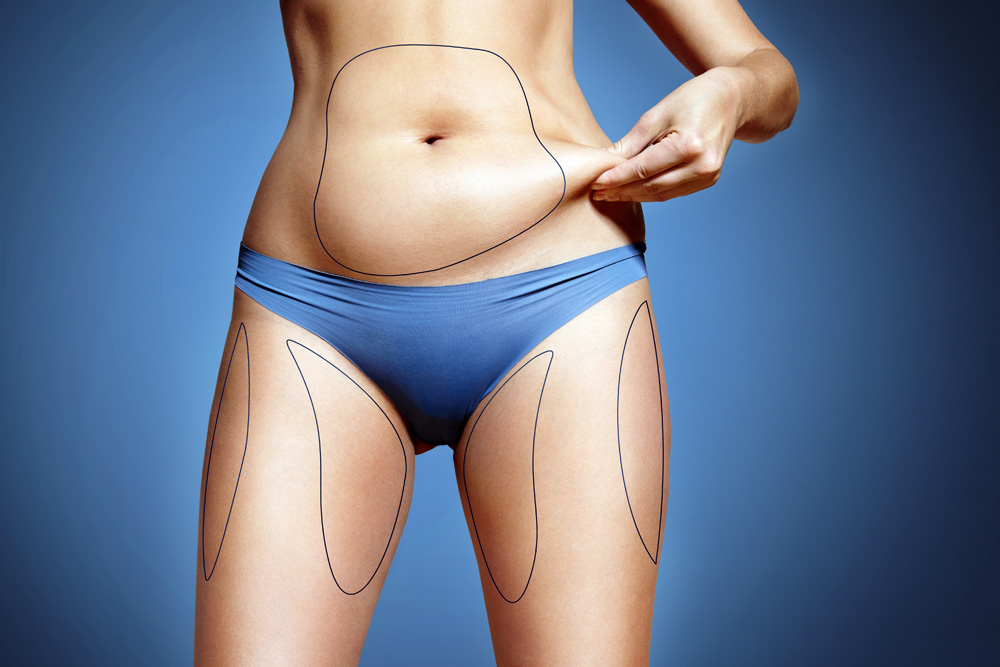 Say Goodbye to Stubborn Fat with Cryolipolysis: Your Guide to Cool Treatment Liposuction